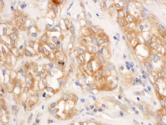 RELA / NFKB p65 Antibody - Detection of Human by Immunohistochemistry. Sample: FFPE section of human breast carcinoma. Antibody: Affinity purified rabbit anti- used at a dilution of 1:1000 (1 Detection: DAB.