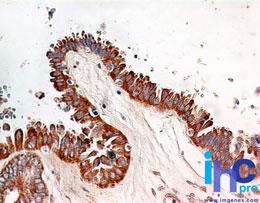 RELA / NFKB p65 Antibody - Immunohistochemistry-Paraffin: NFkB p65 Antibody (112A1021) [Azide Free] - Formalin-fixed, paraffin-embedded ovarian cystadenocarcinoma probed with p65 antibody at 5 ug/ml. Human tissue TMA was used for this test.Staining of formalin-fixed tissues is enhanced by boiling tissue sections in 10 mM sodium citrate buffer, pH 6.0 for 10-20 min followed by cooling at RT for 20 min. This image was taken for the unmodified form of this product. Other forms have not been tested.