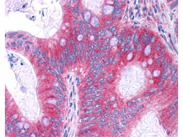 RELA / NFKB p65 Antibody - Antibody 200-301-065 has been tested in immunohistochemistry, analyzed by an anatomic pathologist and validated for use in IHC applications against formalin-fixed, paraffin-embedded human tissues. showed moderate to strong staining within many tissues, including epithelium of the breast, small intestine, kidney, pancreas, prostate, skin, placenta, and uterus, as well as within neurons and lymphoid tissues such as spleen, thymus, and tonsil. The antibody produced an excellent signal with almost no background staining at a concentration of 2.5 ug/ml. The image displayed shows specific staining in colon carcinoma as the precipitated red signal, with a hematoxylin purple nuclear counterstain.