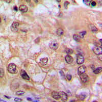 RELA / NFKB p65 Antibody - Immunohistochemical analysis of NF-kappaB p65 staining in human breast cancer formalin fixed paraffin embedded tissue section. The section was pre-treated using heat mediated antigen retrieval with sodium citrate buffer (pH 6.0). The section was then incubated with the antibody at room temperature and detected using an HRP conjugated compact polymer system. DAB was used as the chromogen. The section was then counterstained with hematoxylin and mounted with DPX.