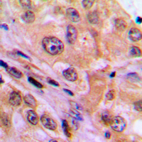 RELA / NFKB p65 Antibody - Immunohistochemical analysis of NF-kappaB p65 staining in human lung cancer formalin fixed paraffin embedded tissue section. The section was pre-treated using heat mediated antigen retrieval with sodium citrate buffer (pH 6.0). The section was then incubated with the antibody at room temperature and detected using an HRP conjugated compact polymer system. DAB was used as the chromogen. The section was then counterstained with hematoxylin and mounted with DPX.