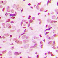 RELA / NFKB p65 Antibody - Immunohistochemical analysis of NF-kappaB p65 (pT435) staining in human breast cancer formalin fixed paraffin embedded tissue section. The section was pre-treated using heat mediated antigen retrieval with sodium citrate buffer (pH 6.0). The section was then incubated with the antibody at room temperature and detected using an HRP-conjugated compact polymer system. DAB was used as the chromogen. The section was then counterstained with hematoxylin and mounted with DPX.