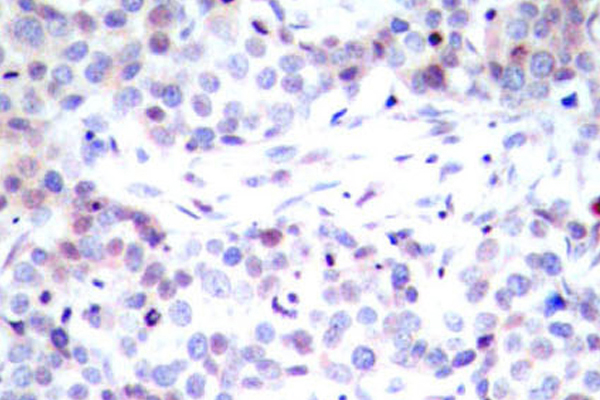 RELA / NFKB p65 Antibody - IHC of NFB-p65 (G530) pAb in paraffin-embedded human breast carcinoma tissue.