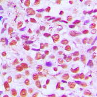 RELA / NFKB p65 Antibody - Immunohistochemical analysis of NF-kappaB p65 staining in human breast cancer formalin fixed paraffin embedded tissue section. The section was pre-treated using heat mediated antigen retrieval with sodium citrate buffer (pH 6.0). The section was then incubated with the antibody at room temperature and detected using an HRP conjugated compact polymer system. DAB was used as the chromogen. The section was then counterstained with hematoxylin and mounted with DPX.