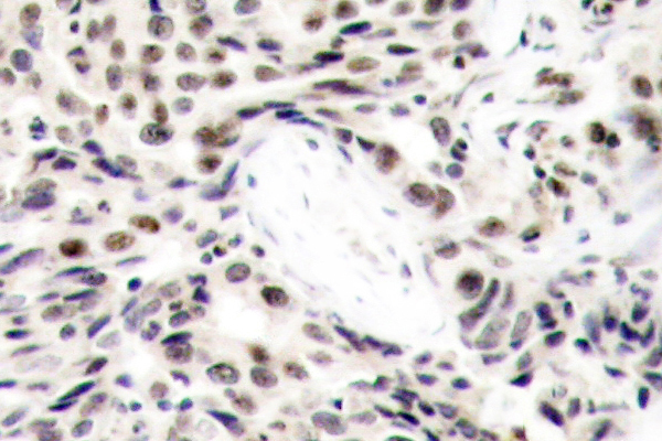 RELA / NFKB p65 Antibody - IHC of NFB-p65 (L523) pAb in paraffin-embedded human breast carcinoma tissue.