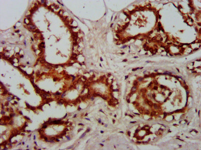 RELA / NFKB p65 Antibody - IHC image of RELA Antibody diluted at 1:600 and staining in paraffin-embedded human breast cancer performed on a Leica BondTM system. After dewaxing and hydration, antigen retrieval was mediated by high pressure in a citrate buffer (pH 6.0). Section was blocked with 10% normal goat serum 30min at RT. Then primary antibody (1% BSA) was incubated at 4°C overnight. The primary is detected by a biotinylated secondary antibody and visualized using an HRP conjugated SP system.