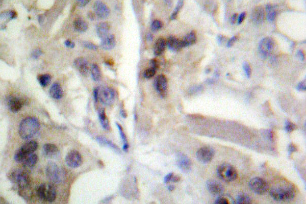 RELA / NFKB p65 Antibody - IHC of NFB-p65 (K303) pAb in paraffin-embedded human breast carcinoma.