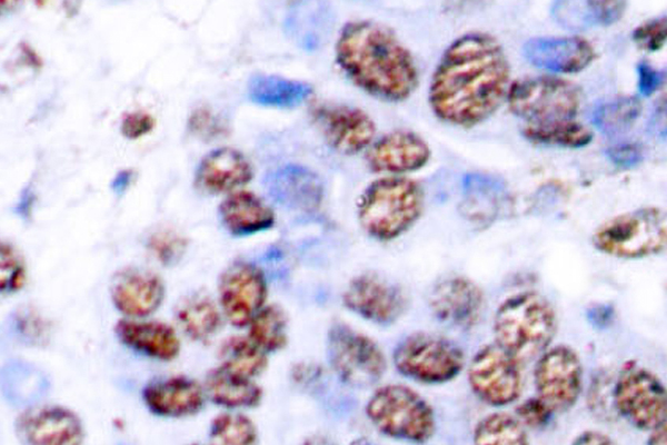 RELA / NFKB p65 Antibody - IHC of NFB-p65 (M270) pAb in paraffin-embedded human breast carcinoma tissue.