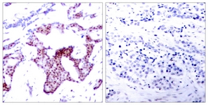 RELA / NFKB p65 Antibody - IHC of paraffin-embedded human breast carcinoma, using NF-kappaB p65 (Phospho-Ser276) Antibody. The picture on the right is treated with the synthesized peptide.