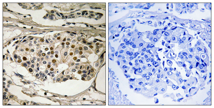 RELA / NFKB p65 Antibody - Immunohistochemistry analysis of paraffin-embedded human breast carcinoma, using NF-kappaB p65 (Phospho-Ser281) Antibody. The picture on the right is blocked with the phospho peptide.
