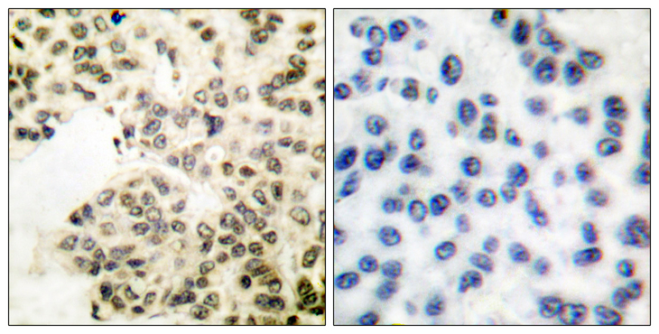 RELA / NFKB p65 Antibody - Immunohistochemistry analysis of paraffin-embedded human breast carcinoma, using NF-kappaB p65 (Phospho-Ser311) Antibody. The picture on the right is blocked with the phospho peptide.