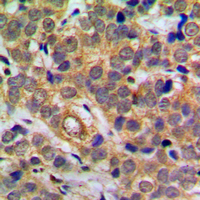 RELA / NFKB p65 Antibody - Immunohistochemical analysis of NF-kappaB p65 (pS311) staining in human breast cancer formalin fixed paraffin embedded tissue section. The section was pre-treated using heat mediated antigen retrieval with sodium citrate buffer (pH 6.0). The section was then incubated with the antibody at room temperature and detected using an HRP conjugated compact polymer system. DAB was used as the chromogen. The section was then counterstained with hematoxylin and mounted with DPX.