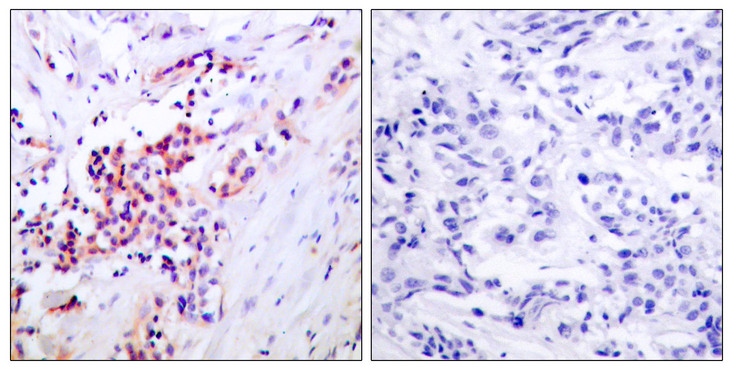 RELA / NFKB p65 Antibody - Immunohistochemistry analysis of paraffin-embedded human breast carcinoma, using NF-kappaB p65 (Phospho-Ser468) Antibody. The picture on the right is blocked with the phospho peptide.