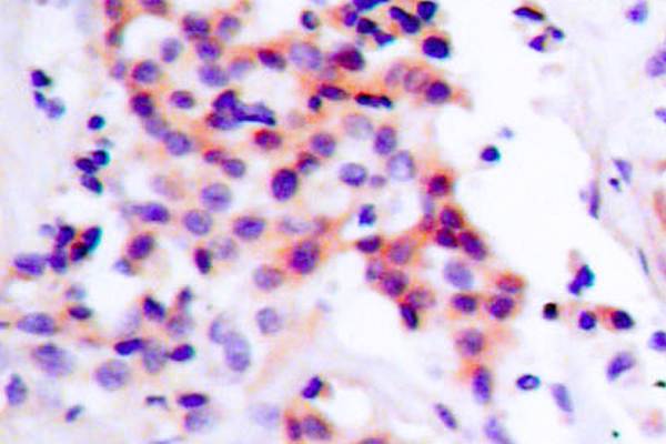 RELA / NFKB p65 Antibody - IHC of p-NFB-p65 (S468) pAb in paraffin-embedded human breast carcinoma tissue.