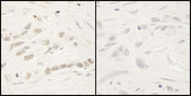 RELA / NFKB p65 Antibody - Detection of Human Phospho-RelA (S468) by Immunohistochemistry. Samples: FFPE serial sections of human linitis plastica stomach cancer. Mock phosphatase treated section (left) or calf intestinal phosphatase-treated section (right) immunostained for Phospho-RelA (S468). Antibody: Affinity purified rabbit anti-Phospho-RelA (S468) used at a dilution of 1:250. Epitope Retrieval Buffer-High pH (IHC-101J) was substituted for Epitope Retrieval Buffer-Reduced pH.