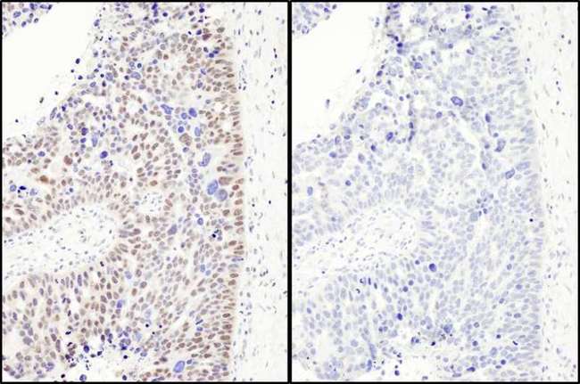 RELA / NFKB p65 Antibody - Detection of Human Phospho RelA (S468) by Immunohistochemistry. Samples: FFPE sections of human ovarian carcinoma. Mock phosphatase treated section (left) and calf intestinal phosphatase-treated section (right). Antibody: Affinity purified rabbit anti-Phospho RelA (S468) used at a dilution of 1:1000 (1 ug/ml). Detection: DAB.