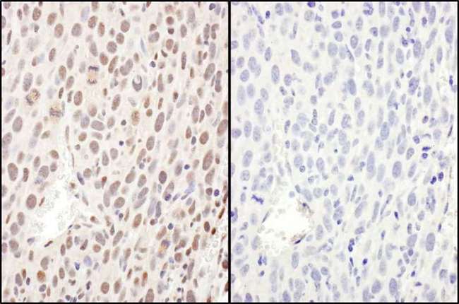 RELA / NFKB p65 Antibody - Detection of Mouse Phospho RelA (S468) by Immunohistochemistry. Samples: FFPE sections of mouse renal cell carcinoma. Mock phosphatase treated section (left) and calf intestinal phosphatase-treated section (right). Antibody: Affinity purified rabbit anti-Phospho RelA (S468) used at a dilution of 1:1000 (1 ug/ml). Detection: DAB.