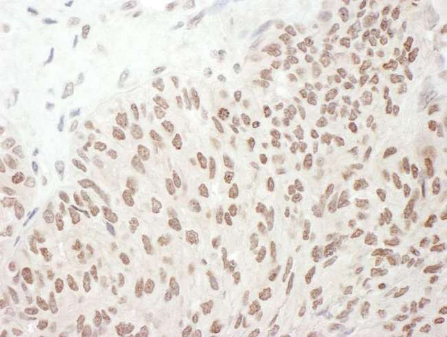RELA / NFKB p65 Antibody - Detection of human Phospho RelA (S468) by immunohistochemistry. Sample: FFPE section of human ovarian carcinoma. Antibody: Affinity purified rabbit anti-Phospho RelA (S468) used at a dilution of 1:1,000 (1µg/ml). Detection: DAB. Counterstain: IHC Hematoxylin (blue).