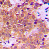 RELA / NFKB p65 Antibody - Immunohistochemical analysis of NF-kappaB p65 (pS468) staining in human breast cancer formalin fixed paraffin embedded tissue section. The section was pre-treated using heat mediated antigen retrieval with sodium citrate buffer (pH 6.0). The section was then incubated with the antibody at room temperature and detected using an HRP conjugated compact polymer system. DAB was used as the chromogen. The section was then counterstained with hematoxylin and mounted with DPX.