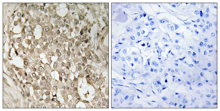 RELA / NFKB p65 Antibody - Immunohistochemistry analysis of paraffin-embedded human breast carcinoma, using NF-kappaB p65 (Phospho-Ser529) Antibody. The picture on the right is blocked with the phospho peptide.