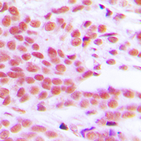 RELA / NFKB p65 Antibody - Immunohistochemical analysis of NF-kappaB p65 (pS529) staining in human breast cancer formalin fixed paraffin embedded tissue section. The section was pre-treated using heat mediated antigen retrieval with sodium citrate buffer (pH 6.0). The section was then incubated with the antibody at room temperature and detected using an HRP conjugated compact polymer system. DAB was used as the chromogen. The section was then counterstained with hematoxylin and mounted with DPX.