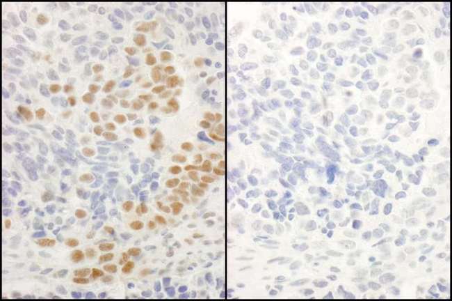 RELA / NFKB p65 Antibody - Detection of Human Phospho-RelA (S536) by Immunohistochemistry. Samples: FFPE serial sections of human ovarian carcinoma. Mock phosphatase treated section (left) or calf intestinal phosphatase-treated section (right) immunostained for Phospho-RelA (S536). Antibody: Affinity purified rabbit anti-Phospho-RelA (S536) used at a dilution of 1:250. Epitope Retrieval Buffer-High pH (IHC-101J) was substituted for Epitope Retrieval Buffer-Reduced pH.