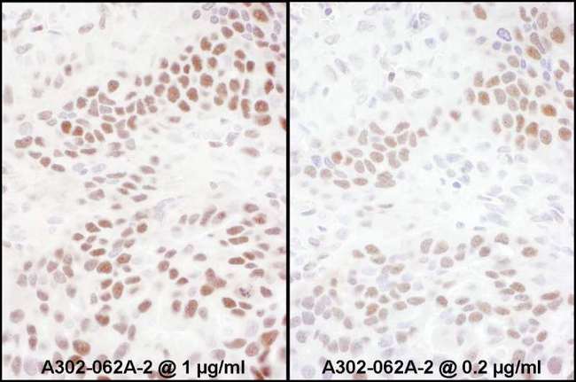 RELA / NFKB p65 Antibody - Detection of Human Phospho RelA (S536) by Immunohistochemistry. Samples: FFPE serial section of human ovarian carcinoma. Antibody: Affinity purified rabbit anti-Phospho RelA (S536) used at a dilution of 1:200 (1 ug/ml) and 1:1000 (0.2 ug/ml). Detection: DAB.