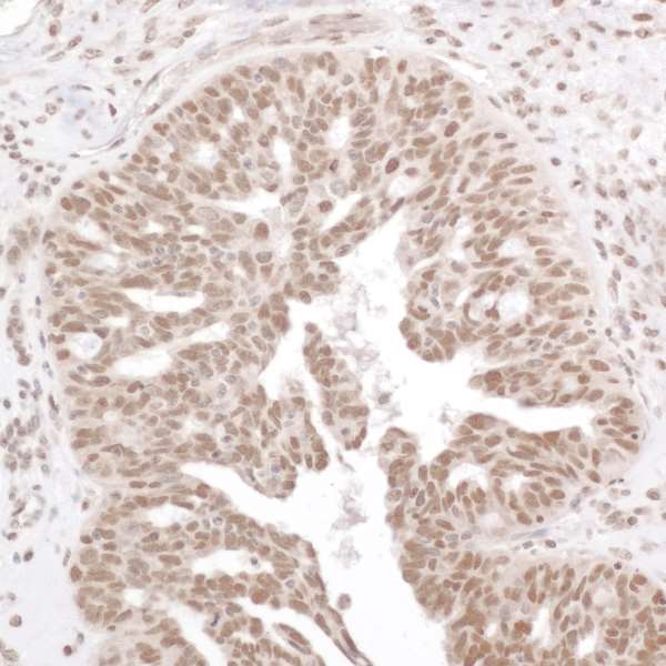 RELA / NFKB p65 Antibody - Detection of human Phospho RelA (S536) by immunohistochemistry. Sample: FFPE section of human ovarian carcinoma. Antibody: Affinity purified rabbit anti-Phospho RelA (S536) used at a dilution of 1:200 (1µg/ml). Detection: DAB Counterstain: IHC Hematoxylin (blue).