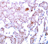 RELA / NFKB p65 Antibody - Immunohistochemical analysis of paraffin-embedded human breast carcinoma tissue.