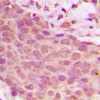 RELA / NFKB p65 Antibody - Immunohistochemical analysis of NF-kappaB p65 (pS536) staining in human breast cancer formalin fixed paraffin embedded tissue section. The section was pre-treated using heat mediated antigen retrieval with sodium citrate buffer (pH 6.0). The section was then incubated with the antibody at room temperature and detected using an HRP conjugated compact polymer system. DAB was used as the chromogen. The section was then counterstained with hematoxylin and mounted with DPX.