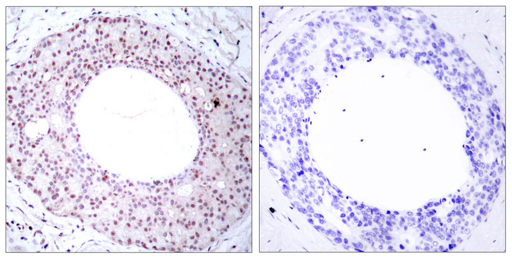 RELA / NFKB p65 Antibody - Immunohistochemistry analysis of paraffin-embedded human breast carcinoma, using NF-kappaB p65 (Phospho-Thr254) Antibody. The picture on the right is blocked with the phospho peptide.