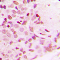 RELA / NFKB p65 Antibody - Immunohistochemical analysis of NF-kappaB p65 (pT254) staining in human breast cancer formalin fixed paraffin embedded tissue section. The section was pre-treated using heat mediated antigen retrieval with sodium citrate buffer (pH 6.0). The section was then incubated with the antibody at room temperature and detected using an HRP-conjugated compact polymer system. DAB was used as the chromogen. The section was then counterstained with hematoxylin and mounted with DPX.