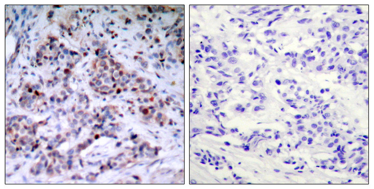 RELA / NFKB p65 Antibody - Immunohistochemistry analysis of paraffin-embedded human breast carcinoma, using NF-kappaB p65 (Phospho-Thr435) Antibody. The picture on the right is blocked with the phospho peptide.