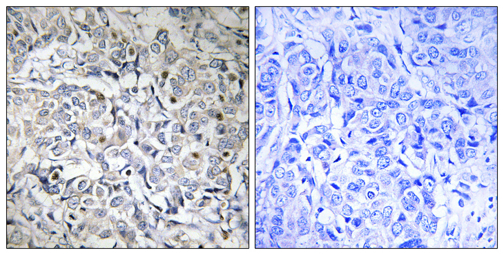 RELA / NFKB p65 Antibody - Immunohistochemistry analysis of paraffin-embedded human breast carcinoma, using NF-kappaB p65 (Phospho-Thr505) Antibody. The picture on the right is blocked with the phospho peptide.