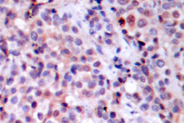 RELA / NFKB p65 Antibody - IHC of NFB-p65 (T429) pAb in paraffin-embedded human breast carcinoma tissue.