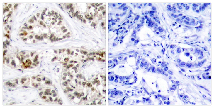 RELB Antibody - Immunohistochemistry of paraffin-embedded human breast carcinoma tissue using RelB(Phospho-Ser573) antibody (left) or the same antibody preincubated with blocking peptide (right).