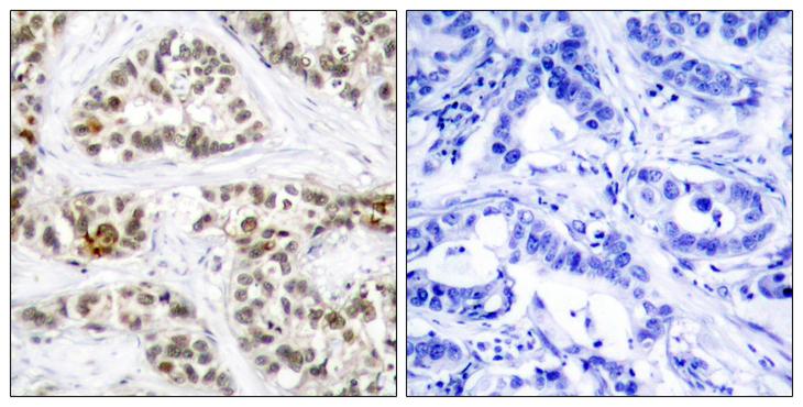 RELB Antibody - P-peptide - + Immunohistochemical analysis of paraffin-embedded human breast carcinoma tissue using RelB (Phospho- Ser552) antibody.