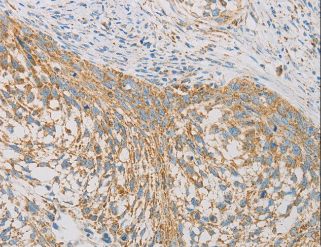 REN / Renin 1 Antibody - Immunohistochemistry of paraffin-embedded Human thyroid cancer using REN Polyclonal Antibody at dilution of 1:40.