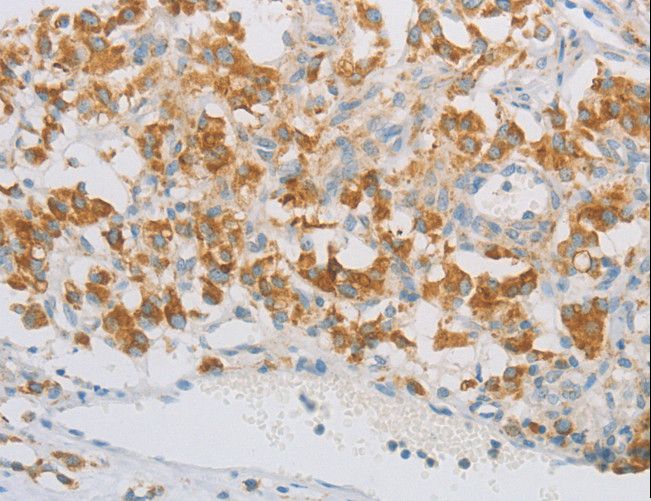 REN / Renin 1 Antibody - Immunohistochemistry of paraffin-embedded Human thyroid cancer using REN Polyclonal Antibody at dilution of 1:40.