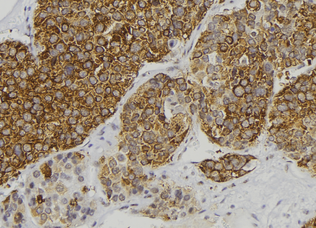 REN / Renin 1 Antibody - 1:100 staining human pancreas tissue by IHC-P. The sample was formaldehyde fixed and a heat mediated antigen retrieval step in citrate buffer was performed. The sample was then blocked and incubated with the antibody for 1.5 hours at 22°C. An HRP conjugated goat anti-rabbit antibody was used as the secondary.