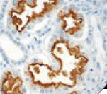 Renal Cell Carcinoma Antibody - IHC of Renal Cell Carcinoma on FFPE Kidney tissue. This image was taken for the unmodified form of this product. Other forms have not been tested.