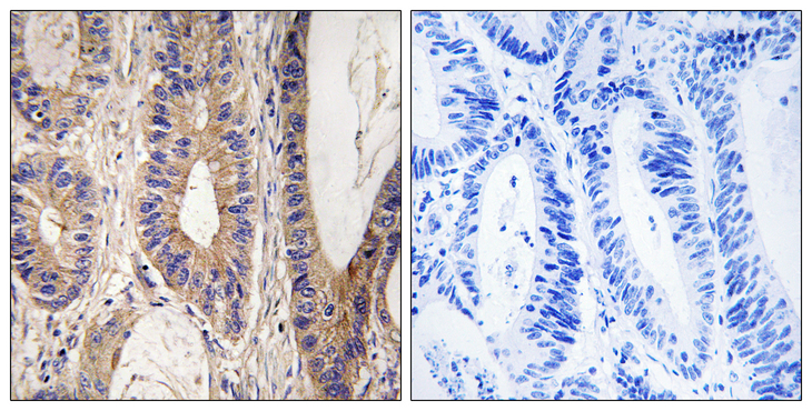 RENT1 / UPF1 Antibody - Immunohistochemistry analysis of paraffin-embedded human colon carcinoma tissue, using UPF1 Antibody. The picture on the right is blocked with the synthesized peptide.