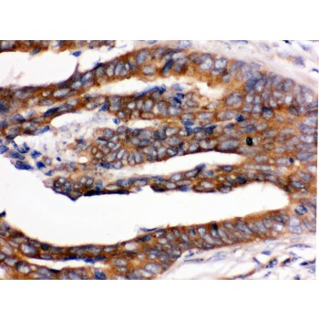 RENT1 / UPF1 Antibody - RENT1/hUPF1 antibody IHC-paraffin. IHC(P): Human Intestinal Cancer Tissue.