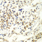 RENT1 / UPF1 Antibody - Immunohistochemistry of paraffin-embedded human liver cancer tissue.