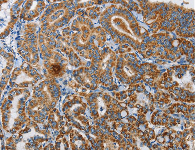 RENT1 / UPF1 Antibody - Immunohistochemistry of paraffin-embedded Human thyroid cancer using UPF1 Polyclonal Antibody at dilution of 1:35.