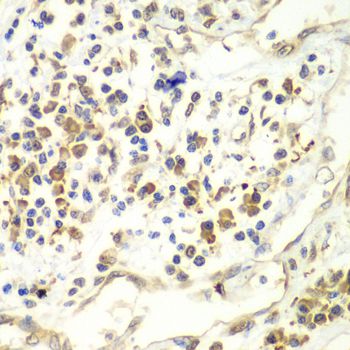 RENT1 / UPF1 Antibody - Immunohistochemistry of paraffin-embedded human liver cancer using UPF1 antibody at dilution of 1:100 (40x lens).