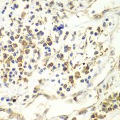 RENT1 / UPF1 Antibody - Immunohistochemistry of paraffin-embedded human liver cancer using UPF1 antibody at dilution of 1:100 (40x lens).