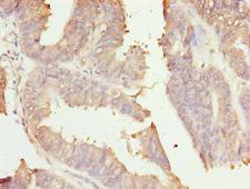 RER1 Antibody - Immunohistochemistry of paraffin-embedded human endometrial cancer using RER1 Antibody at dilution of 1:100