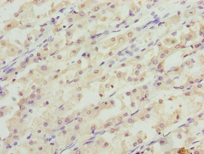 RER1 Antibody - Immunohistochemistry of paraffin-embedded human gastric cancer using RER1 Antibody at dilution of 1:100