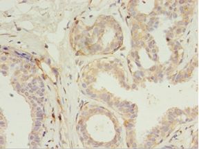 RERG Antibody - Immunohistochemistry of paraffin-embedded human breast cancer using antibody at 1:100 dilution.  This image was taken for the unconjugated form of this product. Other forms have not been tested.